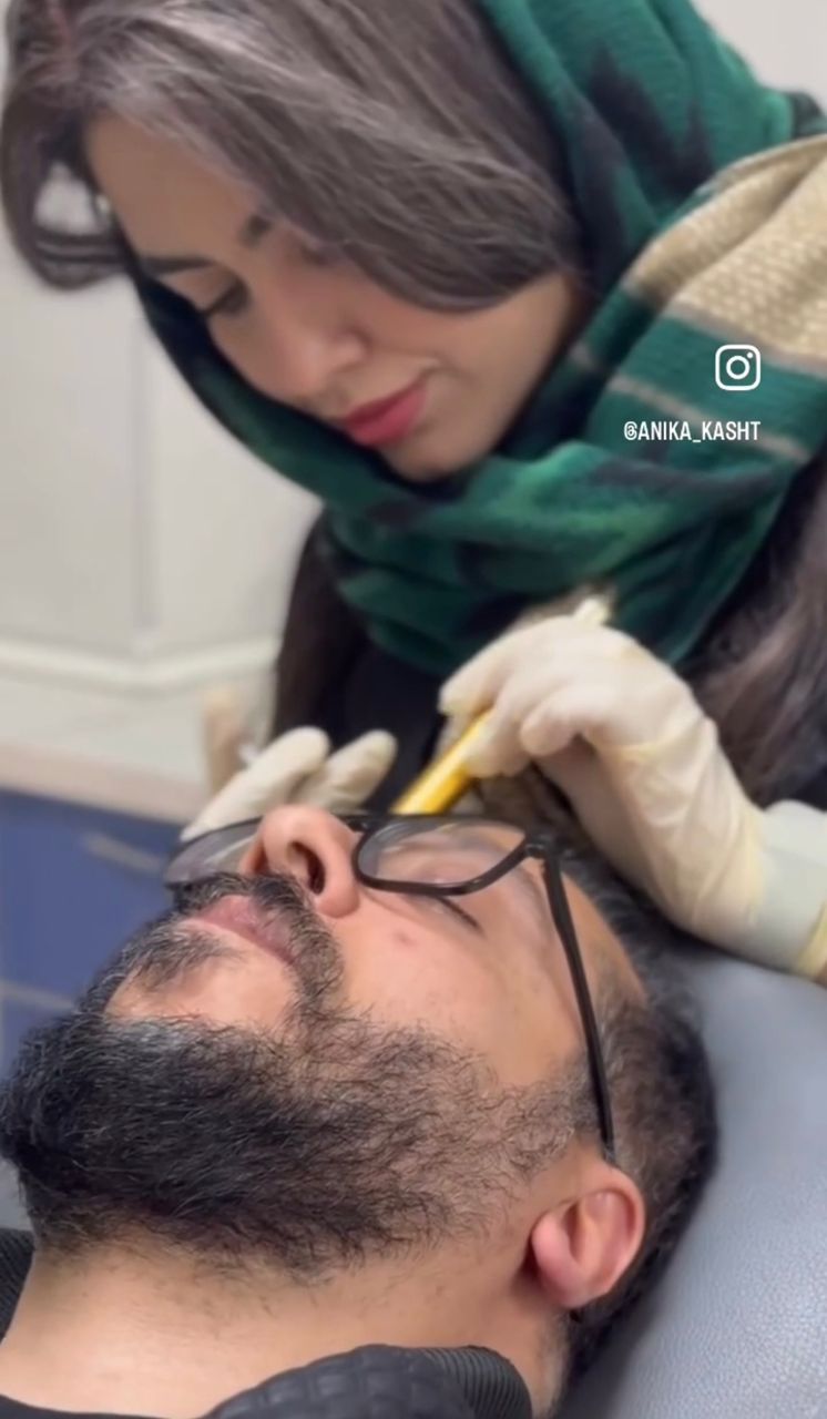 کاشت مو بعد از پنج ماه !!!!!